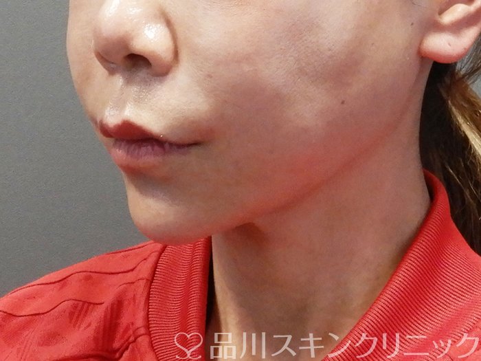 症例NO.72812のBEFORE写真