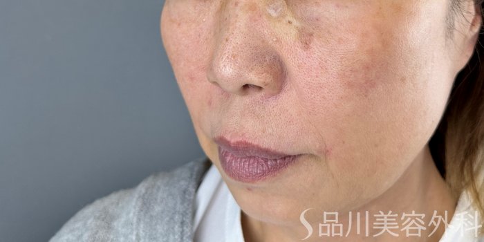 症例NO.72412のAFTER写真