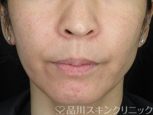 症例NO.64993のBEFORE写真