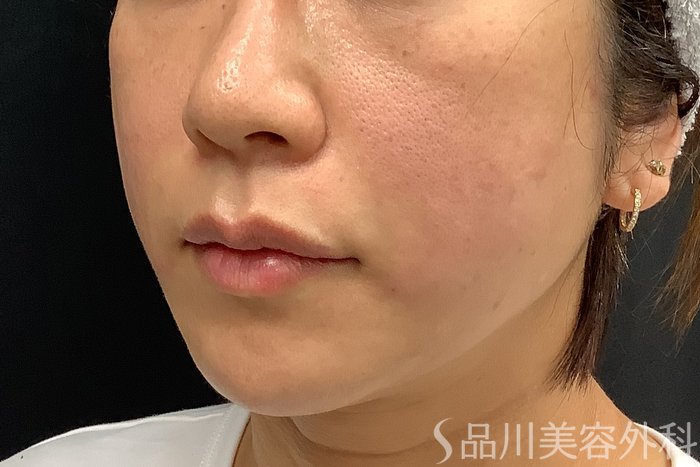 症例NO.73312のAFTER写真