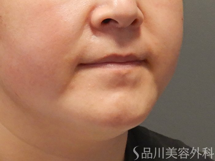 症例NO.68026のBEFORE写真