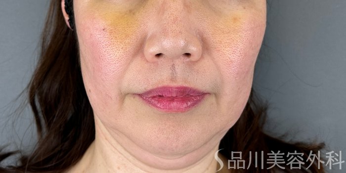 症例NO.67950のBEFORE写真