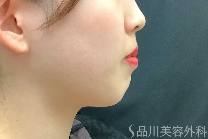 症例NO.69705のBEFORE写真