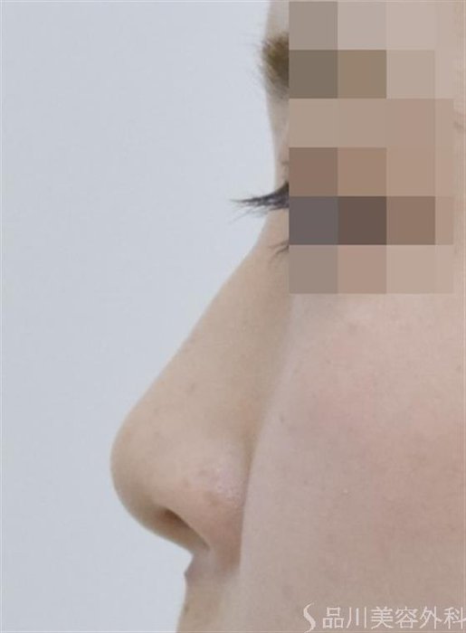 症例NO.51176のBEFORE写真