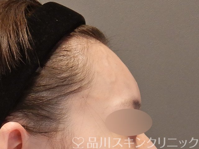 症例NO.75351のAFTER写真