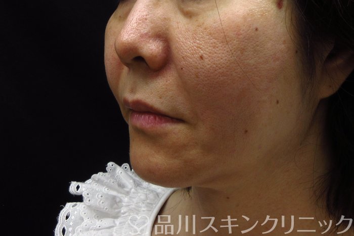 症例NO.74320のAFTER写真