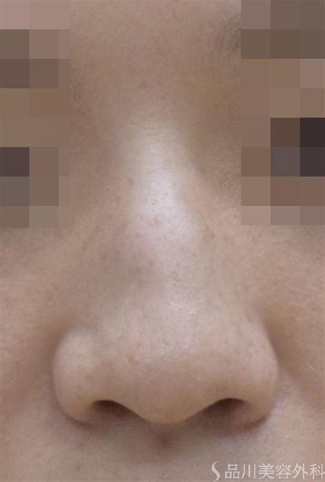 症例NO.51781のBEFORE写真