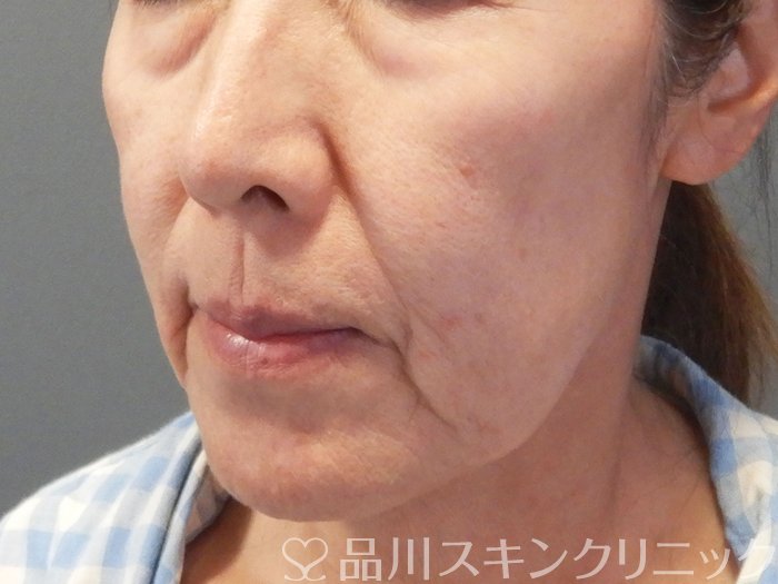 症例NO.69477のBEFORE写真