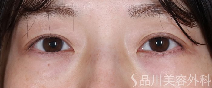 症例NO.72419のBEFORE写真