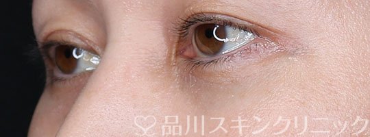 症例NO.69670のAFTER写真