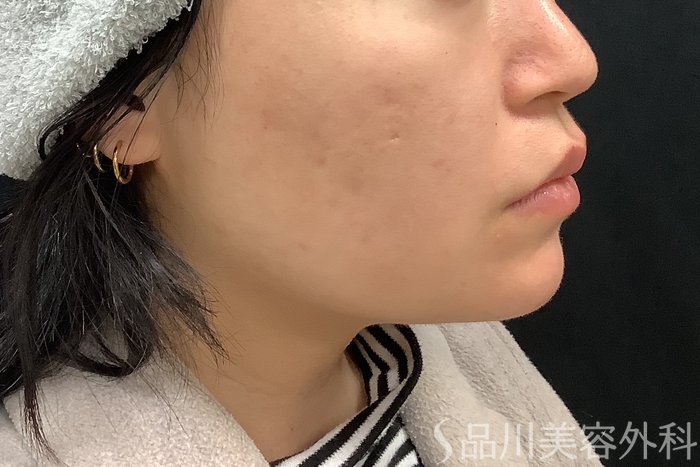 症例NO.69513のAFTER写真
