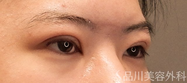 症例NO.72319のAFTER写真