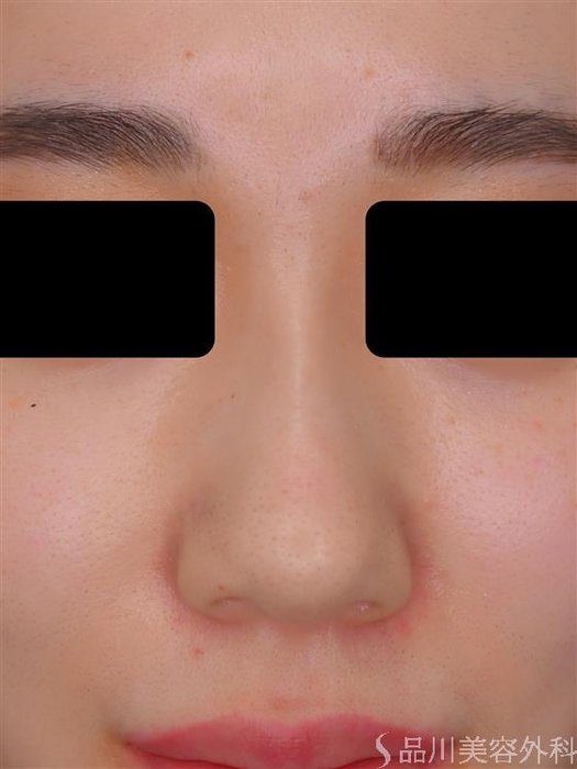 症例NO.55046のBEFORE写真