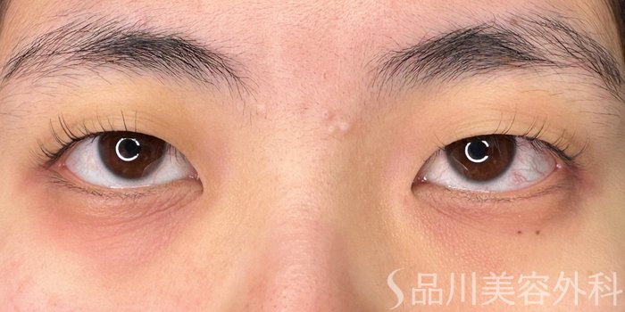 症例NO.73984のBEFORE写真