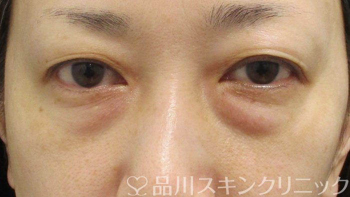 症例NO.74291のBEFORE写真