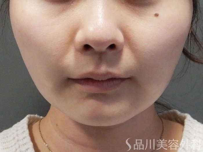 症例NO.70046のAFTER写真