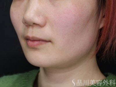 症例NO.73702のBEFORE写真