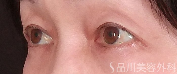 症例NO.69521のBEFORE写真