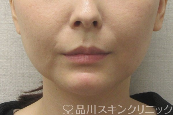 症例NO.72405のAFTER写真