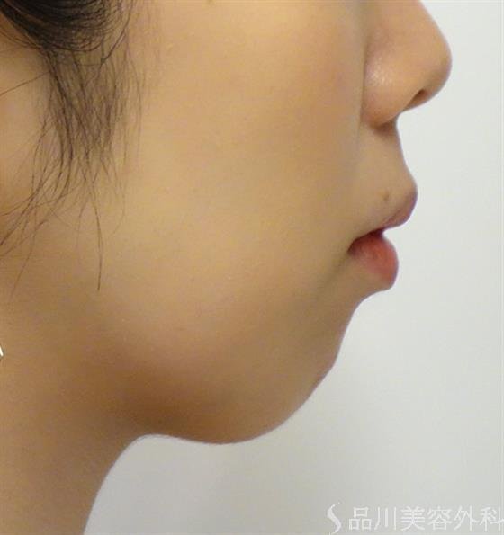 症例NO.37244のBEFORE写真