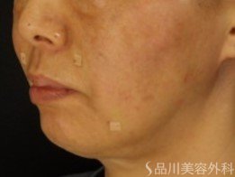 症例NO.70996のAFTER写真