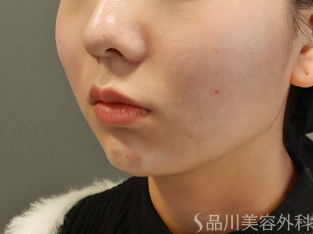 症例NO.73509のAFTER写真