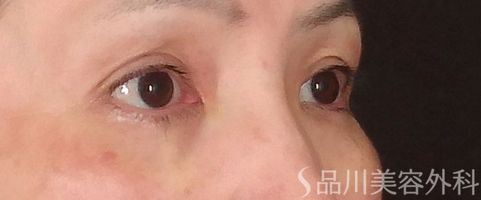 症例NO.70126のAFTER写真