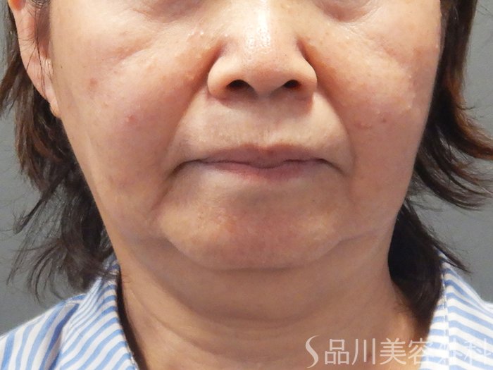 症例NO.72163のBEFORE写真