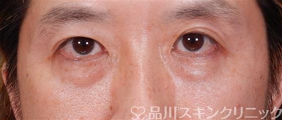 症例NO.56481のBEFORE写真