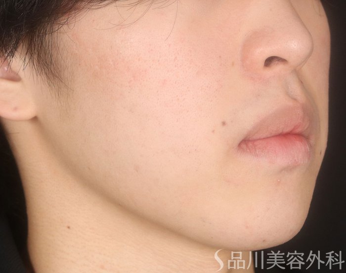 症例NO.73066のAFTER写真