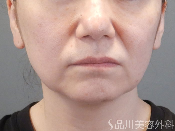 症例NO.74992のBEFORE写真