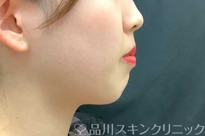 症例NO.69705のBEFORE写真