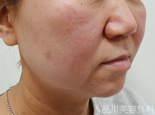 症例NO.73437のBEFORE写真