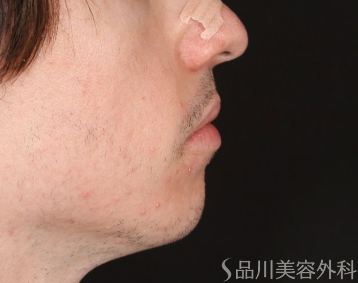 症例NO.71625のBEFORE写真