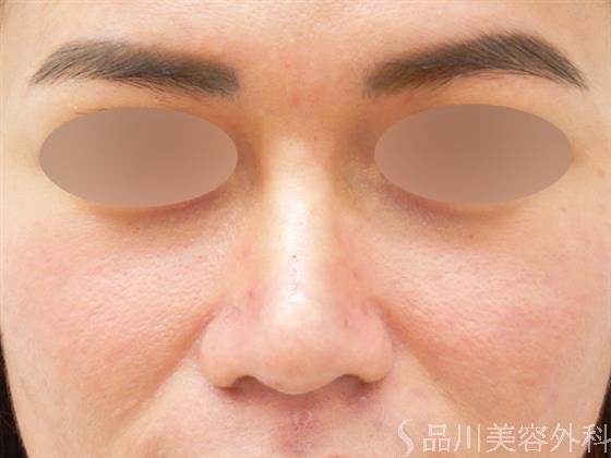 症例NO.52217のAFTER写真