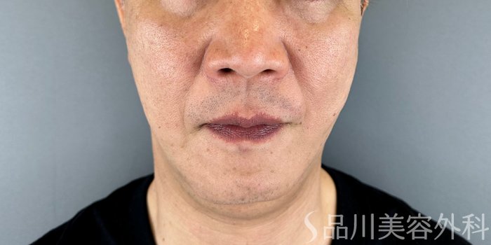 症例NO.65651のAFTER写真