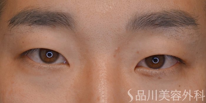症例NO.74204のBEFORE写真