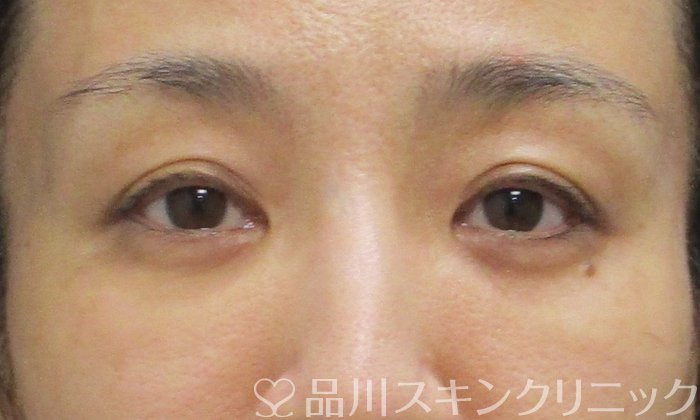 症例NO.69763のAFTER写真