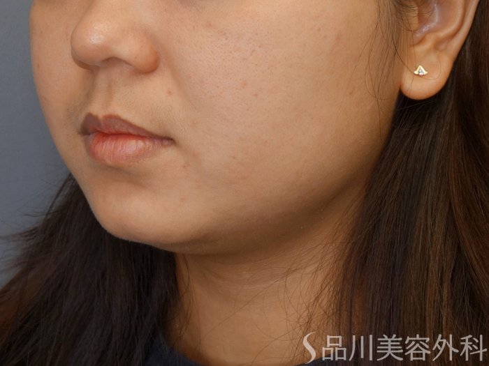 症例NO.70582のBEFORE写真