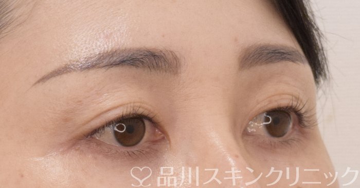 症例NO.75017のBEFORE写真