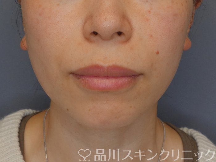 症例NO.72439のBEFORE写真