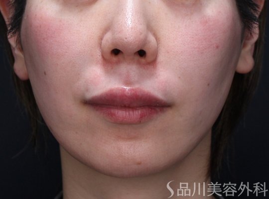 症例NO.73541のAFTER写真