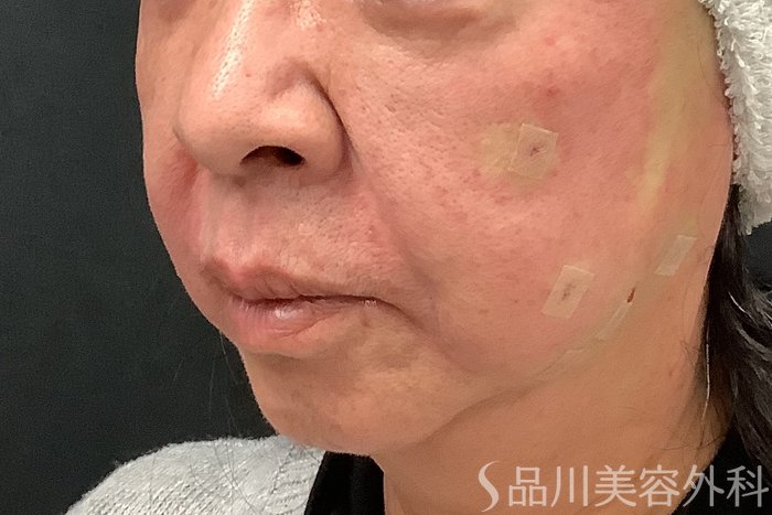 症例NO.65190のAFTER写真