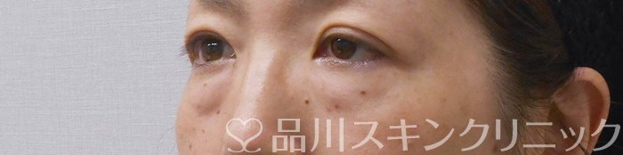 症例NO.72408のBEFORE写真