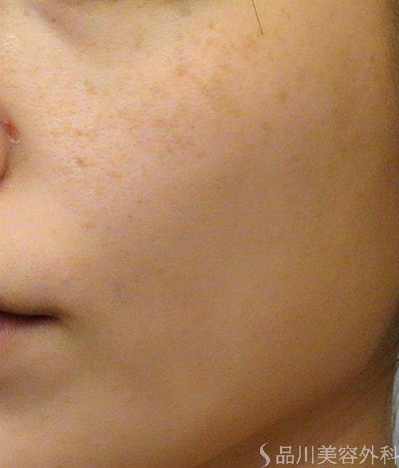 症例NO.37368のBEFORE写真