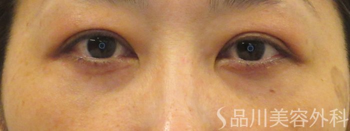 症例NO.72192のAFTER写真