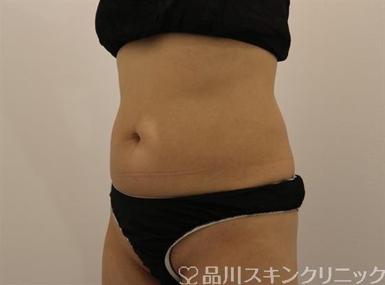 症例NO.43616のAFTER写真
