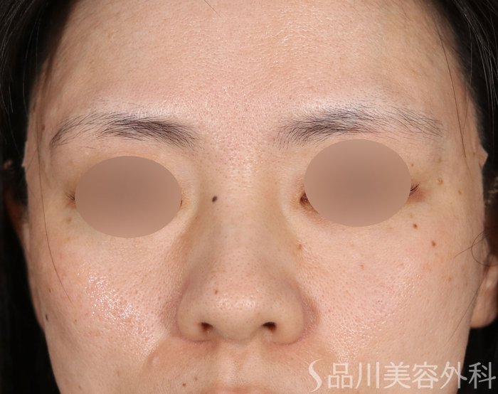 症例NO.71824のAFTER写真