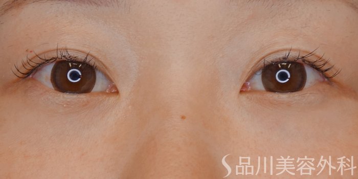 症例NO.71737のBEFORE写真