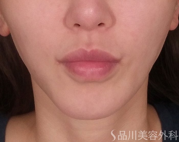 症例NO.73640のBEFORE写真